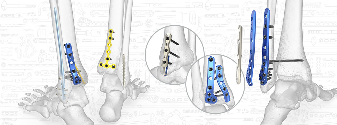 left trimalleolar ankle fractures dislocations