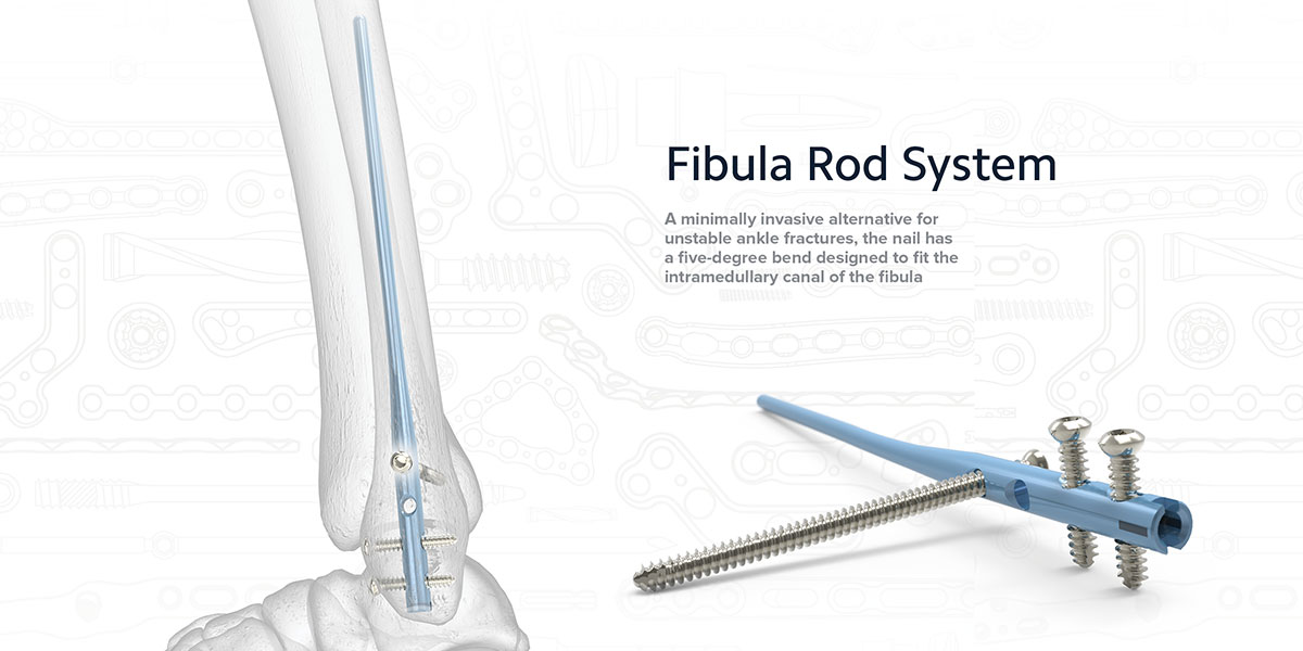 Fibula Rod