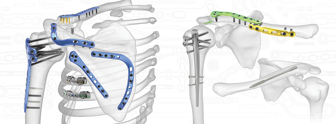 Pectoral Girdle Fractures