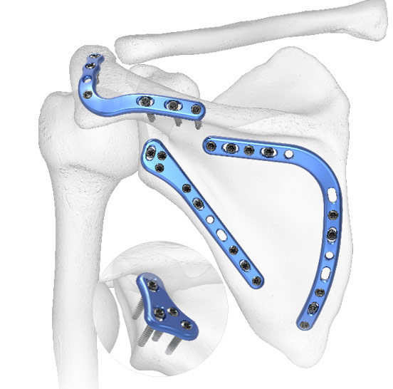 Scapula Es Acumed Information